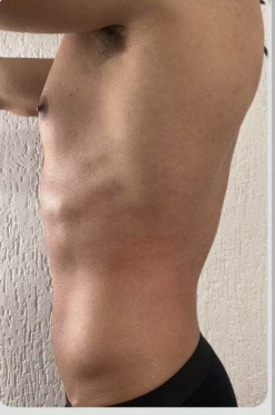 abdômen masculino depois do tratamento